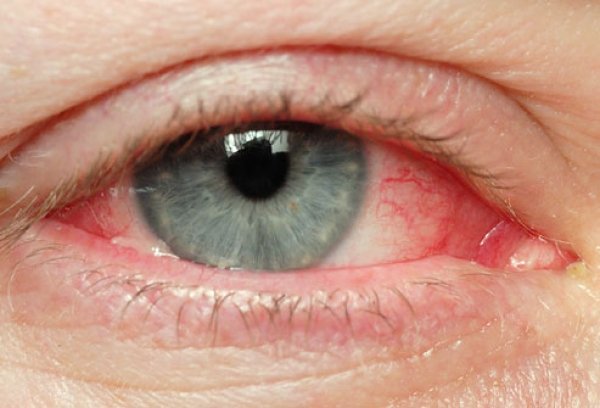 szem kötőhártya gyulladás kezelése házilag anti aging titkok nők számára