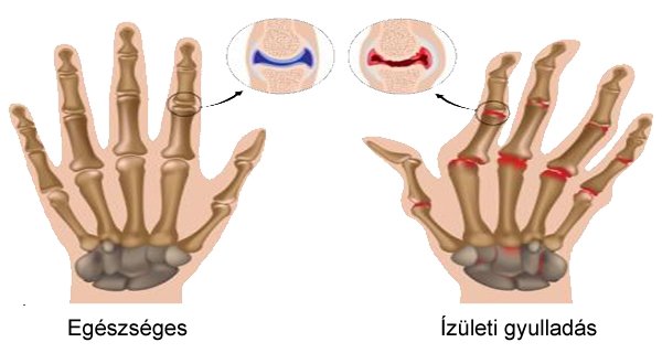 ha a jobb kéz vállízülete fáj petefészekrák 7 tünete