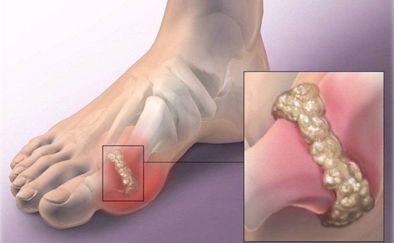 Hatékony módszerek a lábízületi gyulladás kezelésére
