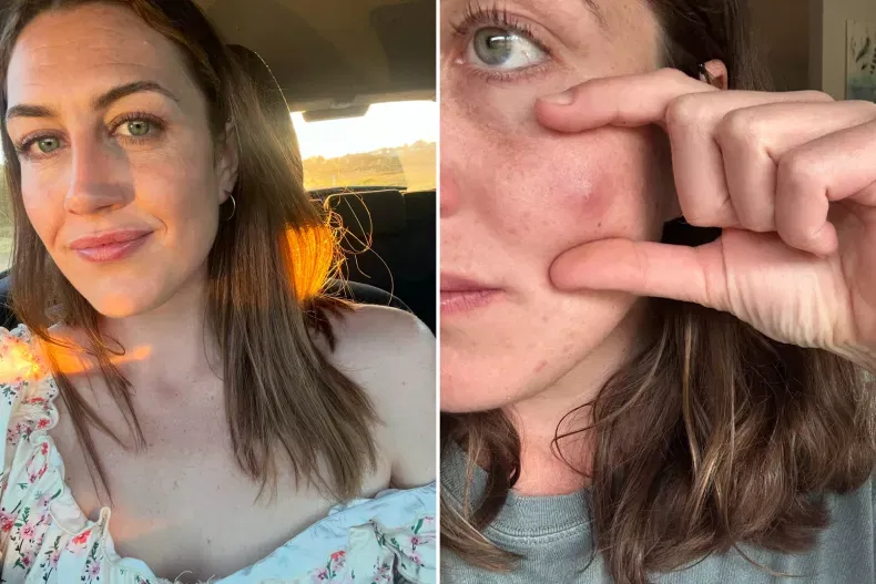 “Azt hittem csak egy egyszerű pattanás lett az arcomra, de az igazság ennél sokkal borzasztóbb volt!”